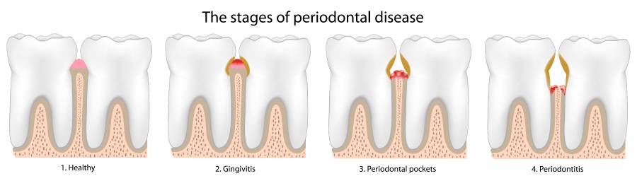 Artistic rendering of the stages of periodontal or gum disease