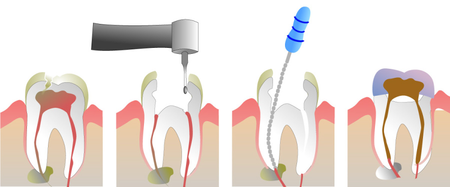 Visual showing four stages of root canal treatment