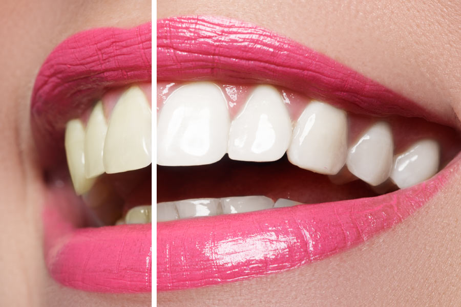 A closeup pink lipped smile showing a whiter half after professional teeth whitening