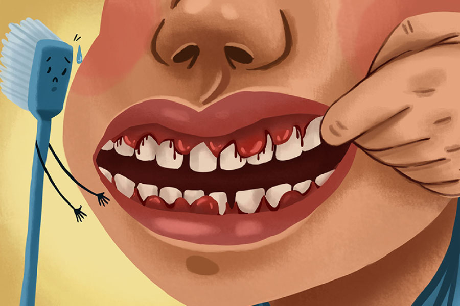 Cartoon of a mouth with bleeding gums indicative of gum disease.