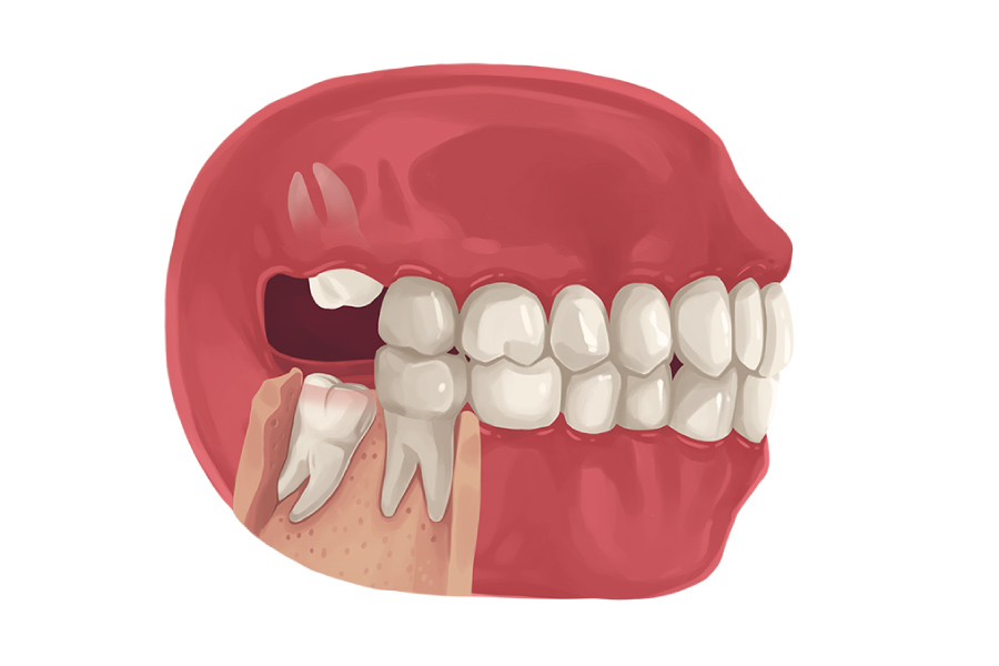 Model of mouth with wisdom teeth growing in at bad angles.