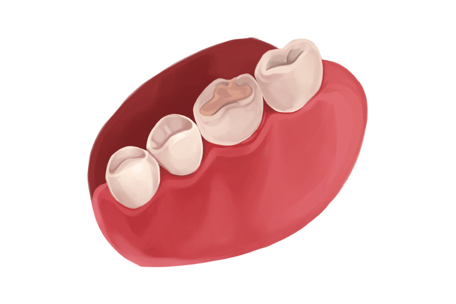 Model showing a composite dental filling.