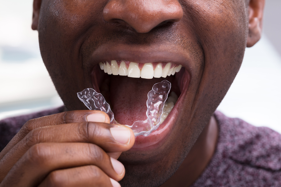 Photograph of Black man with Invisalign clear aligners. 