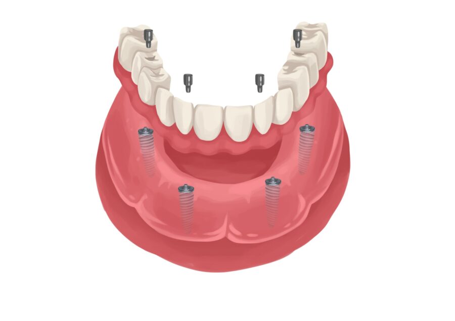 implant-supported denture, dentures, implant-supported dentures
