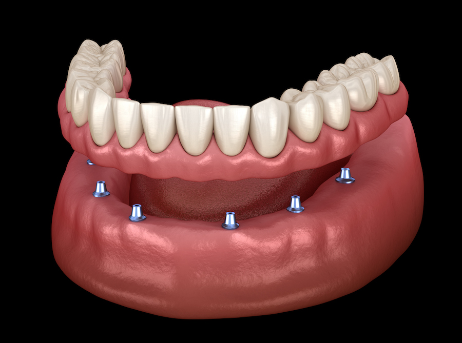 custom dentures, partial dentures, full dentures, implant supported dentures, implant-supported dentures