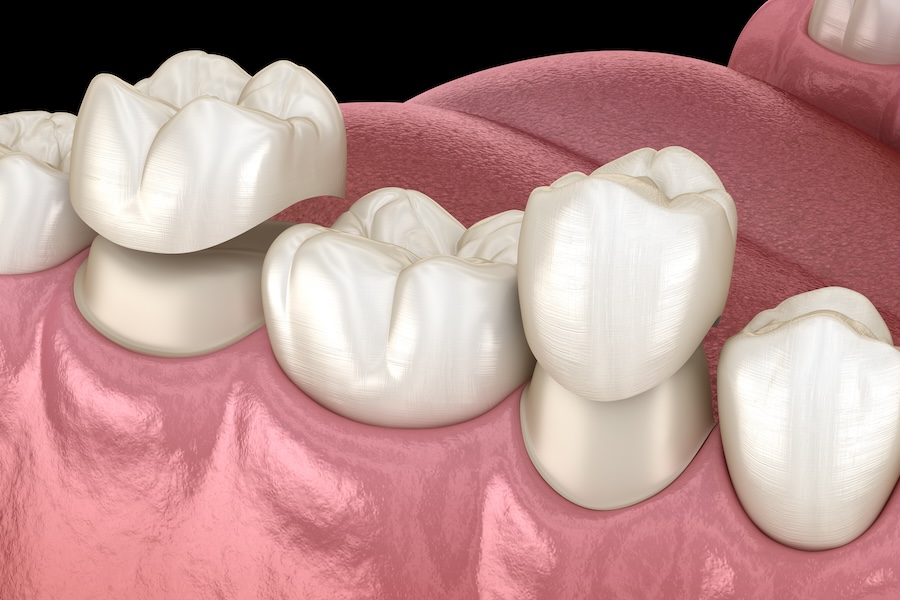 loose dental crown, dental crown care, dental crown repair, crown fell off, Riverstone Dental Care, Coeur d'Alene dentist, Hayden dentist, Post Falls dentist