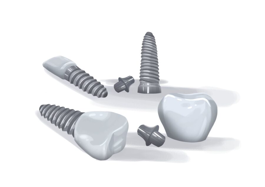 graphic of dental implants, with tips to for implant care at Riverstone Dental Care