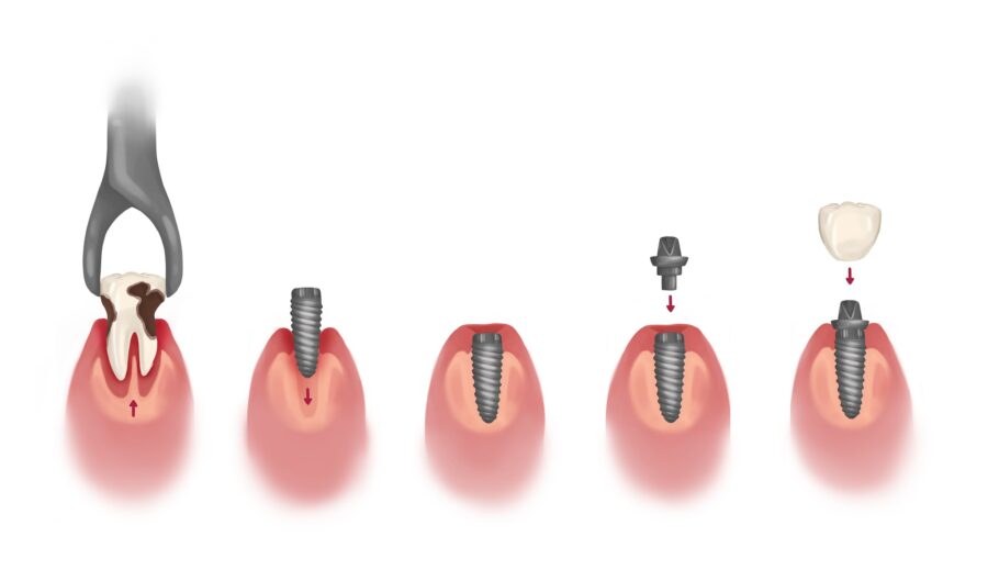 dental implants number of appointments and timeline